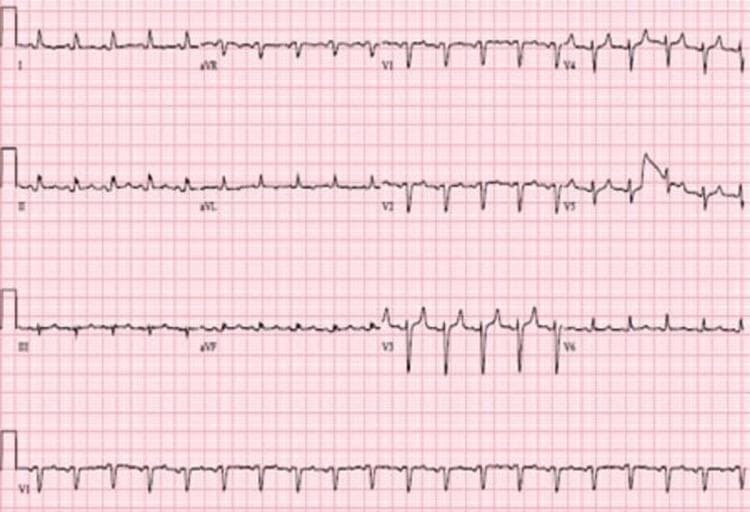 This diagnostic image is a 12-lead electrocardiogram (ECG) strip recorded at a standard paper speed and gain. The tracing demonstrates a regular narrow-complex tachycardia, consistent with sinus tachycardia, characterized by P waves with normal morphology and a consistent relationship with the QRS complexes. A critical finding is the presence of low-voltage QRS complexes, defined as a QRS amplitude of less than 5 mm in the limb leads (I, II, III, aVR, aVL, aVF) and less than 10 mm in the precordial leads (V1-V6). The P waves are upright in lead II and inverted in aVR, confirming a sinoatrial origin. This combination of sinus tachycardia and low voltage is a classic clinical indicator of a large pericardial effusion or cardiac tamponade, as the fluid surrounding the heart attenuates the electrical signal. The rhythm appears regular with a rate exceeding 100 beats per minute, which is common in compensatory states during hemodynamic compromise.