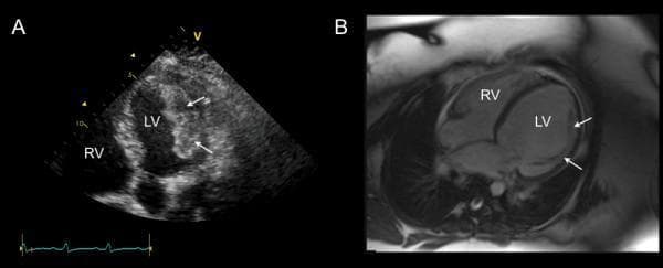 This dual-panel diagnostic image compares a transthoracic echocardiogram (TTE) and a cardiac magnetic resonance (CMR) image of the heart in a patient with peripartum cardiomyopathy. Image A (left) is an apical five-chamber view on TTE, showing a dilated left ventricle (LV) and right ventricle (RV). White arrows point to a large, heterogeneous, layered echodense mass adherent to the lateral wall of the LV, characteristic of an intra-cavitary thrombus. Image B (right) is a four-chamber view from a balanced steady-state free precession (SSFP) CMR sequence taken four days after initiation of anticoagulation. The follow-up image demonstrates near-complete resolution of the previously seen echodense mass. White arrows in Image B highlight the now-visible underlying muscular trabeculations on the endocardial surface of the lateral wall, which were previously obscured by the thrombus. This comparison illustrates the rapid resolution of left ventricular thrombi following medical management in the context of severe biventricular systolic dysfunction.