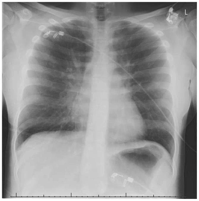 Anteroposterior (AP) chest X-ray of a pediatric/adolescent patient showing signs of severe obstructive airway disease. Key diagnostic features include significant pulmonary hyperinflation, evidenced by increased radiolucency of the lung fields, flattening of the diaphragmatic domes, and a narrowed, elongated 'drop' heart configuration. Prominent hilar vasculature is visible bilaterally. A focal area of increased density in the right middle lobe is suggestive of atelectasis. Multiple medical monitoring devices are present, including radiopaque ECG leads and electrodes positioned on the upper chest and lower abdomen, with associated cabling crossing the thoracic field. The image illustrates the typical radiological manifestations of acute status asthmaticus, specifically air trapping and secondary compensatory changes in the thoracic cavity. This content is relevant for pediatric intensive care (PICU) and respiratory medicine education focusing on the evaluation of acute asthma exacerbations.