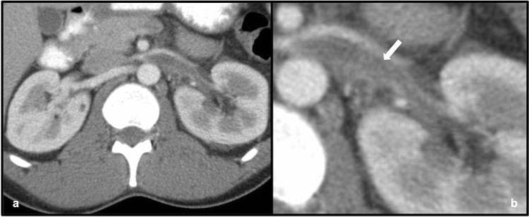 This diagnostic image consists of two axial contrast-enhanced CT views of the abdomen: a wide field-of-view (a) and a magnified narrow field-of-view (b). The images demonstrate the renal anatomy of a 35-year-old male with lupus nephritis. The primary pathological finding is a prominent filling defect within an expanded left renal vein, indicated by the white arrow in image (b). This low-attenuation area within the vessel lumen is characteristic of acute renal vein thrombosis (RVT). For anatomical comparison, the right renal vein appears normal in size and demonstrates uniform contrast enhancement. Both kidneys are visible; while the renal parenchyma is relatively homogenous bilaterally, the left kidney shows subtle enlargement compared to the right. This visual evidence illustrates a significant vascular complication associated with nephrotic-range proteinuria and systemic inflammatory conditions like systemic lupus erythematosus (SLE). The imaging modality effectively distinguishes between the patent right renal vasculature and the obstructive thrombus on the left.