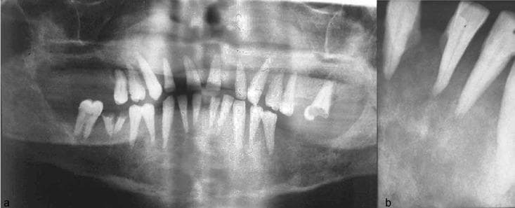This composite diagnostic image features a panoramic radiograph (a) and a periapical radiograph (b) of the human maxilla and mandible, illustrating systemic bone pathology. Image (a) demonstrates generalized demineralization and rarefaction of the jaw bones. Notable findings include an ill-defined inferior alveolar canal, particularly on the right side, and thinning of the mandibular inferior cortex. There is evidence of cortical destruction in the posterior right region and localized resorption on the left. Anatomical landmarks such as the maxillary sinus borders and hard palate appear indistinct. Image (b) shows a detailed periapical view of the anterior incisors, highlighting a complete loss or severe lack of clarity of the lamina dura. Significant vertical bone loss is visible in the interdental regions. These radiographic features are characteristic of metabolic bone diseases or secondary hyperparathyroidism, demonstrating a loss of normal trabecular pattern and cortical definition within the craniofacial skeleton.
