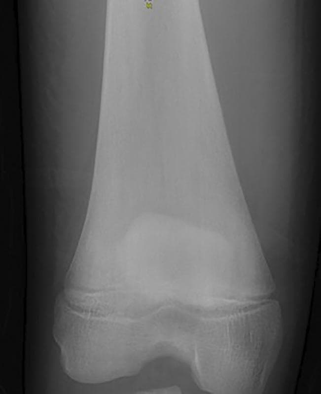 This diagnostic radiograph of the distal femur and knee joint demonstrates a classic 'Erlenmeyer flask deformity.' The image shows an abnormal widening and expansion of the distal femoral metaphysis, where the cortical bone fails to undergo normal modeling, resulting in a bulbous, flared configuration instead of the typical tapered diaphysis-metaphysis transition. Key features include thinning of the cortical margins in the expanded region and heterogeneous bone density with an altered trabecular pattern within the metaphysis. The epiphysis and the knee joint space appear relatively preserved in morphology. This radiographic sign is highly characteristic of marrow infiltrative or metabolic bone disorders, most notably Gaucher disease, where the accumulation of glucocerebroside-laden histiocytes (Gaucher cells) in the bone marrow interferes with normal osteoclast-mediated remodeling. The image is a critical educational tool for identifying skeletal manifestations of lysosomal storage diseases and skeletal dysplasias.