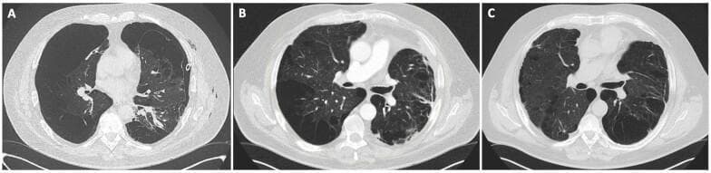 This set of three axial chest CT scans (lung window) illustrates a progression of treatment for severe emphysematous COPD and persistent pneumothorax. Image A shows a significant left-sided pneumothorax following talc pleurodesis, characterized by an absence of peripheral lung markings and compression of the left lung parenchyma against the mediastinum. Image B, captured one month after left-sided lung volume reduction surgery (LVRS), demonstrates successful resolution of the pneumothorax and re-expansion of the left lung. Although severe bullous emphysema remains visible bilaterally, the mediastinum has shifted from a rightward displacement back toward the midline. Image C shows the thorax one month after a subsequent contralateral (right-sided) LVRS. This final stage reveals improved thoracic symmetry and a further reduction in hyperinflation, with more uniform distribution of the remaining lung parenchyma. The series demonstrates the efficacy of sequential LVRS in managing refractory air leaks and optimizing lung mechanics in patients with end-stage emphysema.