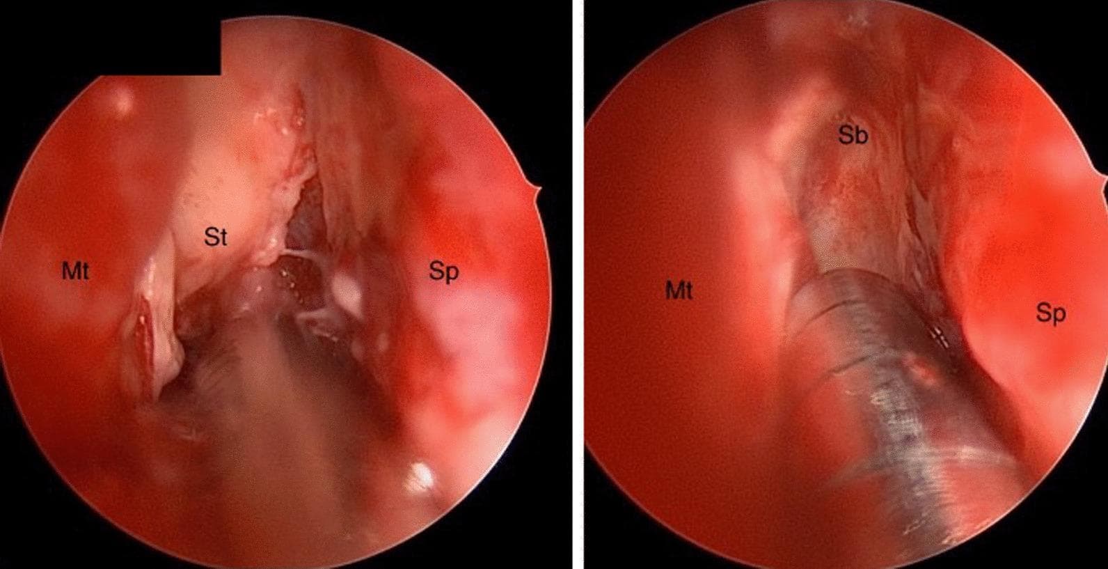 Clinical endoscopic images of the right nasal cavity demonstrating key anatomical landmarks and pathological changes associated with invasive fungal sinusitis. The view identifies the nasal septum (Sp) medially and the middle turbinate (Mt) laterally. Centrally, the superior turbinate (St) exhibits avascular fibrinous conversion, characterized by a pale, blanched tissue appearance lacking normal vascularity. The pathology extends superiorly to the level of the anterior skull base (Sb). Notably, there is an absence of the classic black necrotic eschar frequently observed in advanced invasive fungal infections. The images provide a comparison of the spatial relationships between these structures, with labels highlighting the attachment points at the skull base and the relative positioning of the turbinates. These findings are clinically significant for the early identification of rhinocerebral mucormycosis in high-risk patients, such as those with diabetic ketoacidosis, where tissue devitalization may precede overt necrosis.