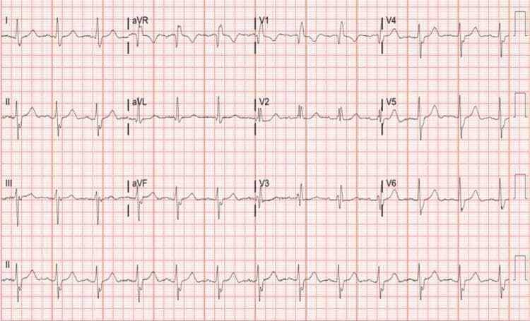 A 12-lead electrocardiogram (ECG) recorded at standard 25 mm/sec and 10 mm/mV, demonstrating normal sinus rhythm with a bifascicular block. The rhythm shows regular P-wave intervals and a normal PR interval. The QRS duration is prolonged (>120 ms), characteristic of a right bundle branch block (RBBB), marked by the classic rSR' pattern in lead V1 and widened S waves in leads I, aVL, and V6. Concomitant left axis deviation is present, evidenced by a predominantly negative QRS complex in lead II and a positive complex in lead aVL, diagnostic of a left anterior fascicular block (LAFB). Secondary repolarization abnormalities, including T-wave inversions, are visible in the right precordial leads (V1-V3), which are expected findings in the setting of RBBB. The tracing serves as a clinical illustration of conduction system disease, specifically bifascicular block, which carries implications for clinical monitoring of potential progression to complete heart block.
