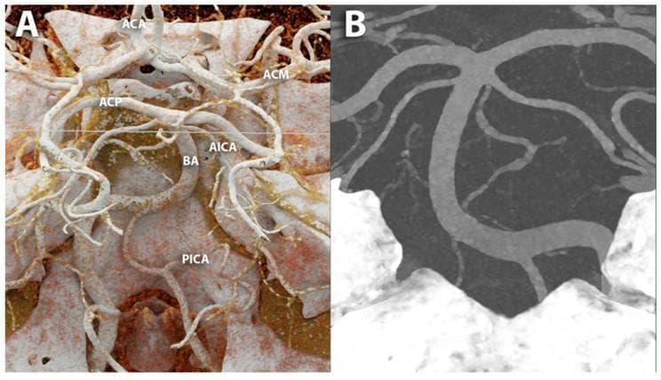 This diagnostic image demonstrates the intracranial arterial anatomy of the Circle of Willis using advanced Photon-Counting CT (PCCT) angiography. The visual is divided into two panels. Panel A utilizes cinematic rendering to provide a high-resolution, three-dimensional spatial overview of the cerebral vasculature. Key labeled structures include the anterior cerebral artery (ACA), middle cerebral artery (ACM), posterior cerebral artery (ACP), and the basilar artery (BA), alongside the anterior inferior cerebellar artery (AICA) and posterior inferior cerebellar artery (PICA). The rendering highlights the complex branching and depth relationships of these vessels within the cranial vault. Panel B presents a Maximum Intensity Projection (MIP) focused on the posterior cerebral circulation, specifically the basilar artery and its branches. This projection emphasizes vascular continuity and the ultra-high-resolution (100 microns) detection of small perforating branches. The image serves as a comparison between different reconstruction techniques in neuroimaging, illustrating the clinical utility of PCCT in evaluating cerebrovascular disease and anatomical variations with high precision.