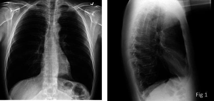 Hugging Face pmc clinical VQA raw