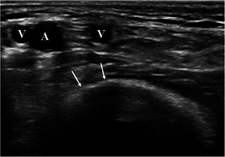 This diagnostic ultrasound image presents a transversal view of the cubital fossa, demonstrating the vascular and bony anatomy relevant for endovascular access. Centrally, the brachial artery (A. brachialis) is identified as an anechoic circular structure labeled 'A'. It is flanked by two brachial veins, labeled 'V', which appear as smaller anechoic lumen. Deep to the vascular bundle, the distal humerus is visualized as a prominent, hyperechoic curvilinear interface indicated by white arrows. This bony surface serves as a mechanical abutment, which is clinically significant for facilitating effective manual compression of the brachial artery following catheterization or needle puncture. The image highlights the utility of ultrasound guidance in identifying optimal puncture sites away from bifurcations and in close proximity to stabilizing skeletal landmarks to minimize access site complications such as hematomas or ischemia.