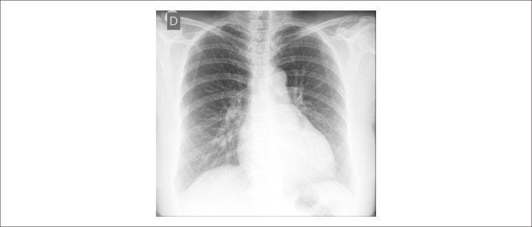 This diagnostic image is a posterior-anterior (PA) chest X-ray of a human adult. The primary finding is significant global cardiomegaly, evidenced by a widened cardiac silhouette that occupies more than 50% of the thoracic diameter, suggesting multi-chamber enlargement. Additionally, the pulmonary vasculature is prominently increased, indicating pulmonary venous hypertension or congestion. This is characterized by increased vascular density and vessel visibility extending into the peripheral lung fields. The hilar regions appear enlarged and dense, consistent with vascular engorgement. The costophrenic angles appear relatively clear on this view, and the bony structures of the thorax are intact. This clinical photograph is used in medical education to illustrate the radiological hallmarks of congestive heart failure or advanced valvular heart disease, such as mitral regurgitation or chronic biventricular dilation.