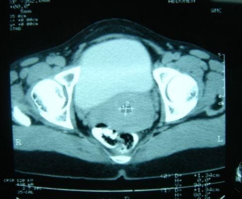 This axial Contrast-Enhanced Computed Tomography (CECT) scan depicts a cross-section of the female pelvis at the level of the internal genitalia. Key anatomical landmarks include the pelvic bones (hip bones and sacrum) appearing as high-attenuation, hyperdense structures. Centrally, the urinary bladder is visible as a moderately distended, fluid-filled organ with low-to-intermediate attenuation. Positioned immediately posterior to the bladder is the uterus, which presents as a well-defined, ovoid soft-tissue structure with homogenous density and normal enhancement, showing no evidence of focal masses or structural distortion. Posterior to the uterus, the rectum or distal sigmoid colon is visible containing pockets of air (hypodense/black areas). The surrounding musculature and pelvic fat planes are well-preserved. Clinically, this image serves to demonstrate the normal appearance and spatial orientation of the internal pelvic organs in a 42-year-old patient, contrasting with potential pathologies such as ovarian cysts or mesenteric lesions mentioned in the context. The educational focus is on identifying normal pelvic anatomy in cross-sectional imaging.