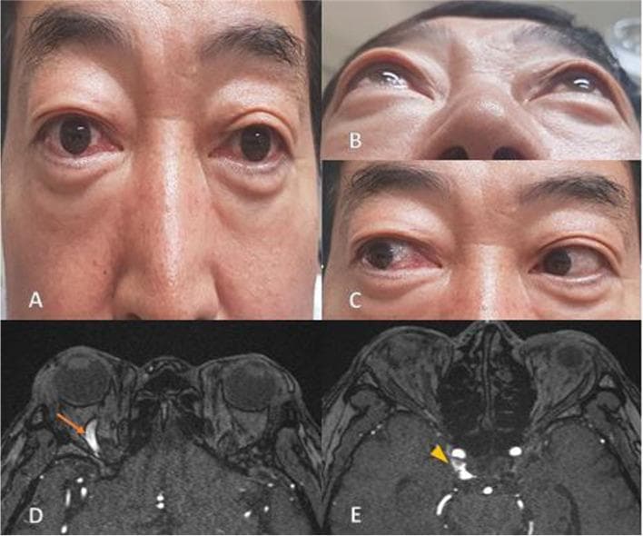 A multi-panel medical image illustrating the clinical and radiological presentation of a carotid-cavernous fistula (CCF). Panels A and B are external clinical photographs showing unilateral right-sided proptosis (exophthalmos) and significant conjunctival injection. Panel C demonstrates a limitation in lateral gaze in the right eye, accompanied by chemosis and prominent, engorged corkscrew episcleral vessels. Panels D and E are axial Magnetic Resonance Angiography (MRA) slices of the brain and orbits. In Panel D, an orange arrow points to a dilated and engorged right superior ophthalmic vein (SOV), a hallmark sign of retrograde venous flow. Panel E features a yellow arrowhead indicating abnormal enhancement near the right internal carotid artery, representing a vascular shunt within the cavernous sinus. This composite image is used for educational purposes to correlate external ophthalmic signs—such as pulsatile proptosis and conjunctival arterialization—with diagnostic neuroimaging findings in neuro-ophthalmology.
