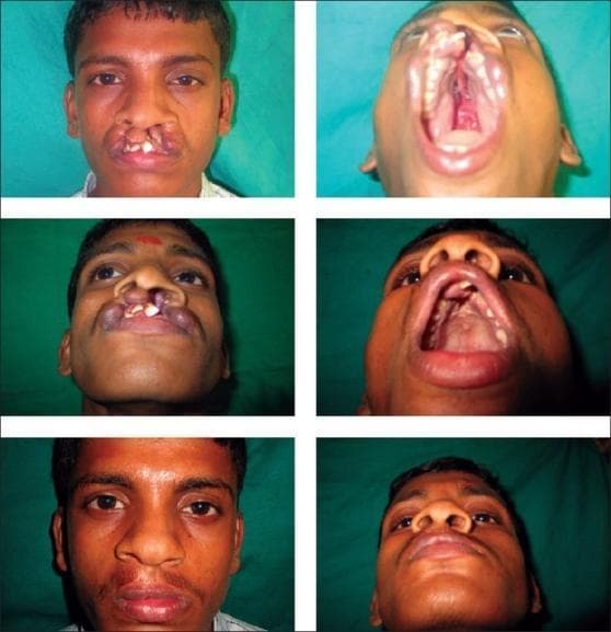 This clinical procedural image series documents the pre-operative and post-operative states of a patient with a complete bilateral cleft lip and palate. The pre-operative photographs (top and middle rows) demonstrate a significant protrusion of the premaxilla, with visible discontinuity of the upper lip and primary palate. There is a marked malposition of the maxillary anterior teeth, exhibiting proclination and rotation. The nasal structure shows a characteristic wide nasal base, flattened alar arches, and a short columella. Submentovertex and intraoral views reveal the extent of the cleft through the hard palate and alveolar ridge. The post-operative photographs (bottom row) show the results of a primary surgical repair. Visible improvements include the reconstruction of the orbicularis oris muscle, restoration of the vermilion border, and narrowing of the nasal floor. The nasal tip projection is increased, and the alar bases are repositioned to improve symmetry. The repair demonstrates the transition from a functional and aesthetic disruption to a more anatomical facial structure, highlighting the management of soft tissue and skeletal components in craniofacial reconstructive surgery.