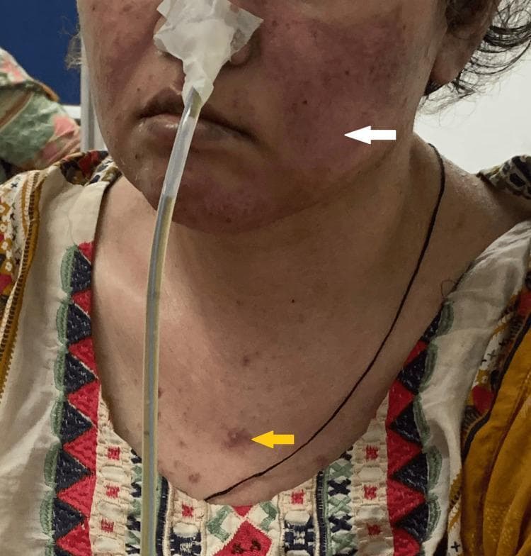 Clinical photograph of a female patient presenting with characteristic dermatological manifestations of Systemic Lupus Erythematosus (SLE). A white arrow points to a malar rash, also known as a butterfly rash, which is characterized by fixed erythema and slight edema across the bridge of the nose and the malar eminences of the cheeks, typically sparing the nasolabial folds. A yellow arrow indicates a discoid rash on the upper chest, appearing as a well-demarcated, erythematous, raised papule/plaque with a slightly hyperpigmented or scarred center. The patient also has a nasogastric tube in place, secured with tape, and appears to have thin hair, potentially representing non-scarring alopecia. The clinical significance of these visual findings is their role as diagnostic criteria in rheumatology for SLE. The presentation is suitable for intermediate to advanced medical education regarding autoimmune connective tissue diseases and cutaneous lupus manifestations.