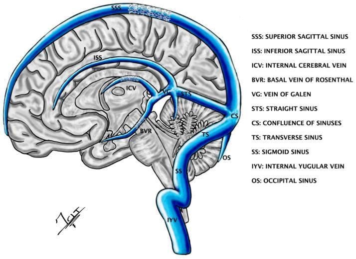 A medical anatomical diagram showing a sagittal cross-section of the human brain with the cerebral venous sinus system overlaid in blue. Key structures labeled include the superior sagittal sinus (SSS) running along the superior margin, the inferior sagittal sinus (ISS) within the falx cerebri, and the straight sinus (STS) connecting to the confluence of sinuses (CS). Deep venous structures shown include the internal cerebral vein (ICV), basal vein of Rosenthal (BVR), and the vein of Galen (VG). The posterior drainage pathway is illustrated via the transverse sinus (TS), sigmoid sinus (SS), and occipital sinus (OS), ultimately draining into the internal jugular vein (IYV). The diagram highlights the theoretical placement of 'STENTrodes' within the SSS and deep veins (BVR/ICV) for endovascular neuromodulation of cortical and subcortical targets like the thalamus and brainstem. This illustration serves as an educational tool for understanding the transvenous approach to deep brain stimulation and the spatial relationship between dural venous sinuses and deep neuroanatomy.