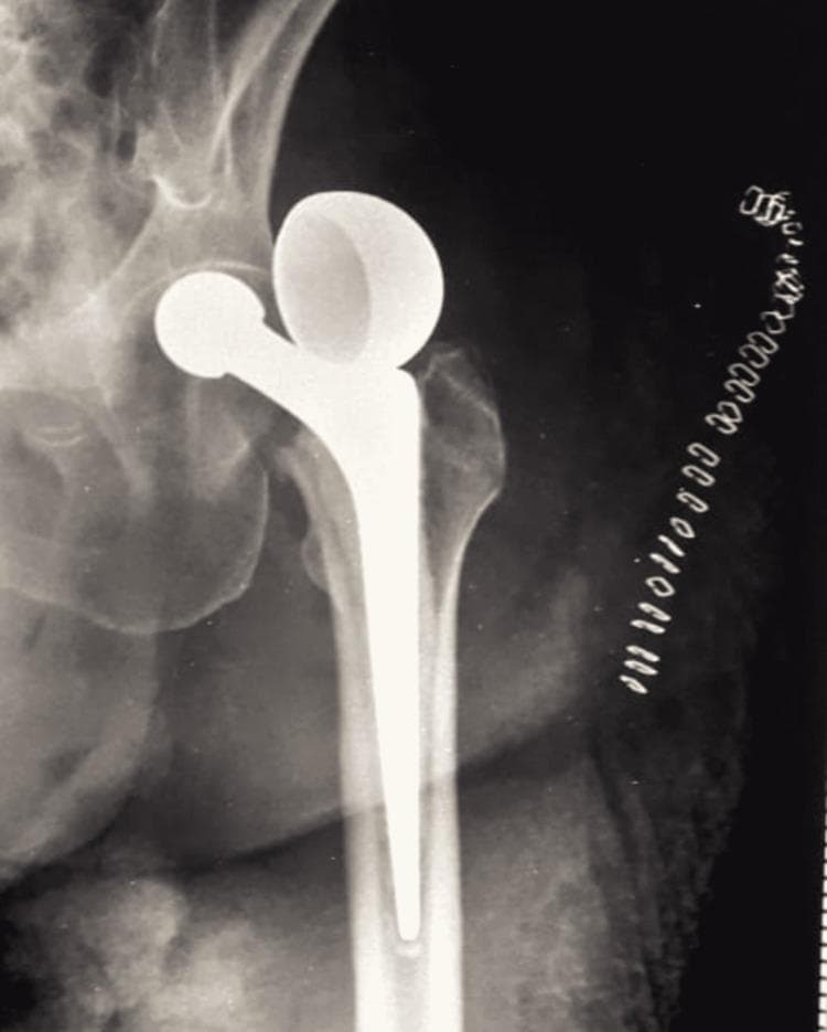 This diagnostic image is an anteroposterior plain X-ray of the left hip joint demonstrating a serious orthopedic complication following surgery. The image shows a bipolar hemiarthroplasty prosthesis with two distinct abnormalities: dislocation and uncoupling. The femoral stem remains situated within the femoral shaft; however, the bipolar prosthetic head has completely detached (uncoupled) from the femoral neck component. This dissociated prosthetic head is seen lying superior and lateral to the native acetabulum in the supracetabular soft tissues. Visible anatomical structures include the pelvis, the acetabular rim, and the proximal femur. Surgical skin staples are visible along the lateral soft tissue margin, indicating recent operative intervention. This case illustrates a rare failure mode of bipolar hip arthroplasty, where the modular components separate, leading to prosthetic dislocation and loss of joint articulation. It is a critical finding for medical students and residents in orthopedic surgery and emergency medicine.