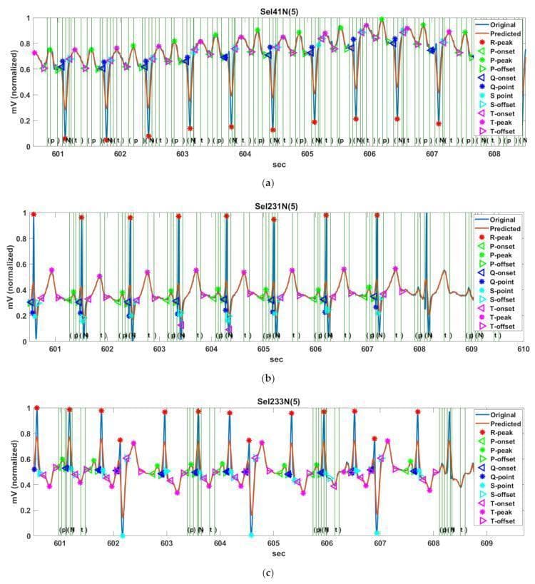 This diagnostic image displays three electrocardiogram (ECG) tracings, labeled (a) Sel41N(5), (b) Sel231N(5), and (c) Sel233N(5), illustrating fiducial point (FP) detection for PQRST complexes. Each panel plots normalized voltage (mV) against time (sec), featuring automated markers for R-peaks, P-waves, Q-points, S-points, and T-waves, including their respective onsets and offsets. Tracing (a) demonstrates inverted R-waves with prominent P- and T-waves, characteristic of high-risk cardiac states. Tracing (b) shows normal sinus rhythm with hyperacute T-waves, where the S-offset and T-onset are closely situated. Tracing (c) illustrates an arrhythmia rhythm with inverted T-waves and deep S-waves. Vertical green lines represent ground-truth annotations from the QT database, while colored icons (stars, triangles, circles) indicate predicted points such as P-peak (green asterisk), R-peak (red asterisk), and T-peak (pink asterisk). The image serves as an educational tool for evaluating algorithmic accuracy in identifying cardiac waveform morphology across diverse pathological rhythms including ST-segment changes and conduction abnormalities.
