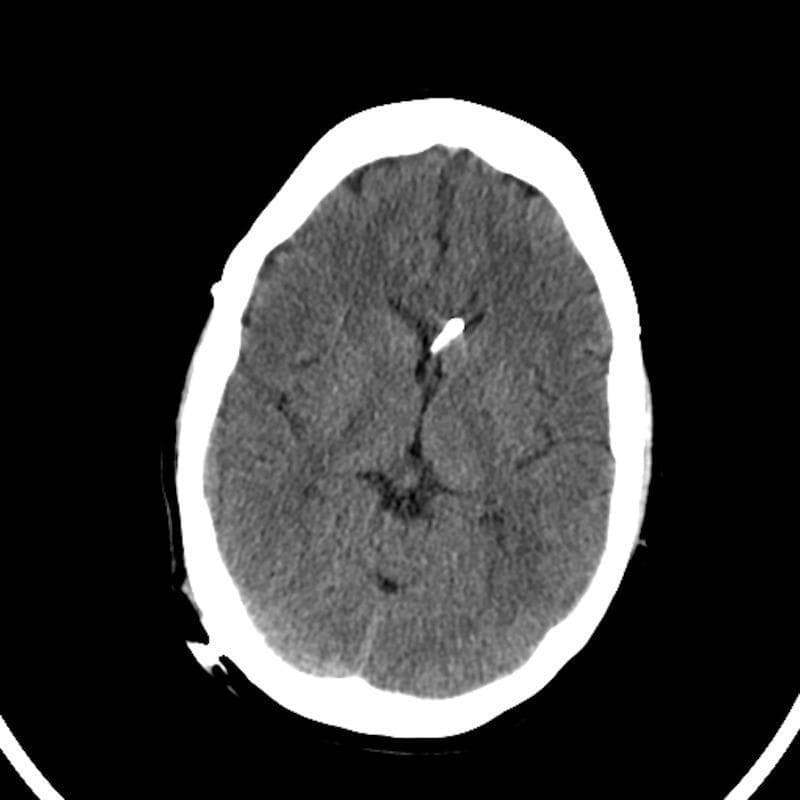 This diagnostic image is an axial non-contrast computed tomography (CT) scan of the brain, demonstrating features consistent with slit ventricle syndrome following surgical intervention. The lateral ventricles are markedly small and slit-like, showing severe compression or decompression from chronic shunting. A hyperdense, linear structure is visible within the right lateral ventricle, consistent with a ventricular shunt catheter. The brain parenchyma appears tightly compacted against the cranial vault, with evidence of effacement of the normal cortical sulci, suggesting restricted intracranial volume relative to the brain mass. The skull is intact and relatively smooth, following a cranial vault expansion procedure as indicated by the clinical context. This image illustrates the neuroimaging appearance of slit ventricles and the associated lack of cerebrospinal fluid space in patients with complex hydrocephalus or craniosynostosis history.
