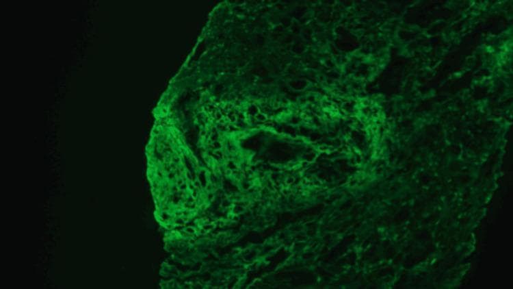 This diagnostic image shows direct immunofluorescence (DIF) of a renal biopsy specimen, specifically highlighting fibrinogen deposition. The image reveals intense, apple-green fluorescence with a heterogeneous distribution. The staining pattern is prominently seen within the walls of a large-caliber renal artery and associated perivascular spaces, appearing as bright, irregular, and somewhat fibrillar or linear deposits. This visual finding is characteristic of necrotizing vasculitis, where fibrinoid necrosis leads to the entrapment of fibrinogen within the damaged vascular walls. The surrounding interstitial tissue displays fainter, more diffuse staining patterns. In the clinical context of ANCA-associated pauci-immune necrotizing vasculitis, this fibrinogen-positive staining serves as a critical marker for active vascular injury, contrasting with the absence of significant immunoglobulin or complement (C3) deposits that would otherwise suggest immune-complex mediated glomerulonephritis. The image is a primary educational resource for nephropathology, illustrating the visual manifestations of vascular necrosis at a microscopic level.