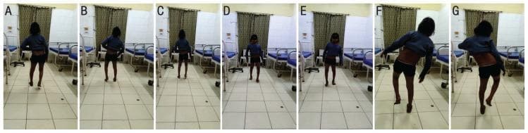 A series of clinical photographs of a 13-year-old female patient demonstrating gait abnormalities and physical examination findings indicative of hip abductor weakness. Panels A through E capture the patient's gait from posterior and anterior views, showing a waddling pattern characterized by lateral trunk oscillations and pelvic instability, consistent with bilateral Trendelenburg gait. Panels F and G display a bilateral positive Trendelenburg test. In these clinical frames, the patient is standing on a single leg; the contralateral side of the pelvis drops (sags) rather than remaining level or rising. To maintain balance and compensate for the pelvic tilt, the patient exhibits a characteristic lateral lean of the torso toward the weight-bearing side. This visual documentation serves as a classic educational representation of gluteus medius and minimus insufficiency, often associated with neuromuscular disorders, proximal myopathies, or hip pathologies. The images clearly illustrate the biomechanical failure of the hip abductor mechanism and the resulting compensatory movements of the upper body and pelvis.