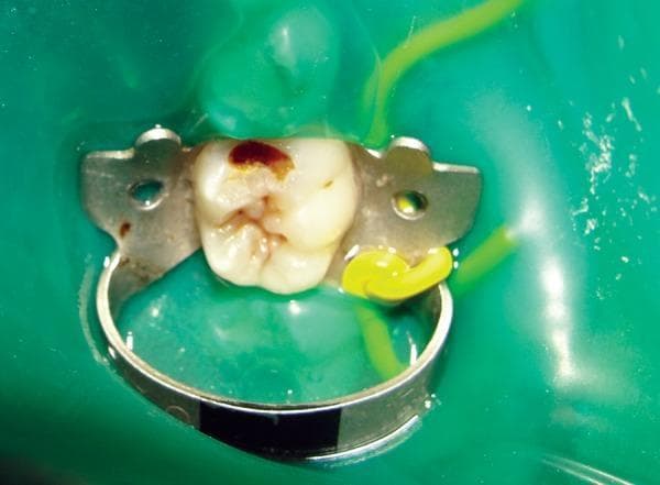 This intraoral clinical photograph shows a preoperative view of a posterior tooth, likely a molar, undergoing dental caries management. The operative field is isolated using a green rubber dam and a metal rubber dam clamp for moisture control and patient safety. The tooth demonstrates a significant carious lesion on the occlusal surface, characterized by a large cavity with dark brown and reddish-brown discolored dentin, indicative of active dental decay. The surrounding enamel appears irregular and thinned. A metal Tofflemire-style matrix band and retainer are positioned around the tooth, stabilized with a yellow interproximal wedge, to establish proper proximal contours during the restorative process. This image serves as an educational example of clinical cariology, isolation techniques, and the preparatory stages for operative dentistry using conventional or chemomechanical caries removal methods.