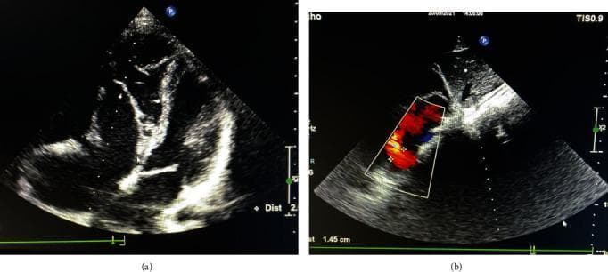 Transthoracic echocardiogram (TTE) images in a patient with Ebstein's anomaly and Atrial Septal Defect (ASD). Panel (a) shows a two-dimensional apical four-chamber view demonstrating cardiac anatomy in situs solitus and levocardia. There is visual evidence of Ebstein anomaly (types B-C), characterized by the apical displacement of the septal tricuspid valve leaflet and subsequent atrialization of the right ventricle. Panel (b) utilizes Color Doppler flow mapping to visualize an atrial septal defect. The Doppler overlay shows a mosaic flow pattern across the interatrial septum, indicating a left-to-right shunt. Linear measurements in panel (b) mark the ASD diameter, which correlates with a 8.3 mm defect. These diagnostic images are essential for evaluating congenital heart disease, assessing valvular displacement, and quantifying shunting in adult congenital cardiology.