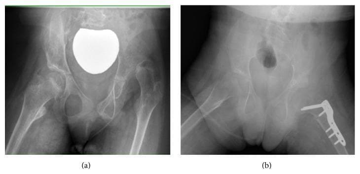This composite diagnostic image features two anteroposterior (AP) pelvic radiographs of a pediatric patient, illustrating preoperative and postoperative states of neuromuscular hip dysplasia secondary to cerebral palsy. Image (a) demonstrates a complete dislocation of the left hip joint. Key radiographic findings include a shallow, dysplastic acetabulum with inadequate superior coverage and a high-riding femoral head. The proximal femur shows a significant valgus deformity (coxa valga). Image (b) displays the results of surgical reconstruction. The left hip is now reduced, with the femoral head centered within the acetabulum. Surgical hardware, including an orthopedic plate and screws, is visible on the proximal femur, indicating a varus derotation osteotomy (VDRO) used to correct the femoral alignment. Structural changes in the ilium above the acetabulum are consistent with a pelvic osteotomy (Dega type) to improve acetabular depth and coverage. These images serve as an educational example of complex hip reconstruction in pediatric orthopedic surgery.