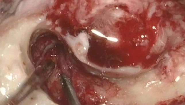 This intraoperative clinical photograph captures the surgical field during an otologic procedure, specifically targeting the middle ear and mastoid spaces. The image demonstrates extensive, hypervascularized granulation tissue located within the aditus ad antrum and extending toward the region of the facial nerve. The pathological tissue is characterized by a deep reddish hue, irregular surface texture, and friable appearance, consistent with active chronic inflammation. Adjacent anatomical structures show signs of inflammatory changes, including pale, edematous-appearing mucosa and areas of whitish exudate or mucosal thickening. Surgical instruments are visible in the lower-left quadrant, performing micro-dissection of the granulation tissue. This finding is clinically significant in the context of Granulomatosis with Polyangiitis (GPA), where such inflammatory masses in the pneumatic spaces can cause facial nerve palsy and hearing loss, necessitating surgical exploration and biopsy for histopathological confirmation and exclusion of malignancy.