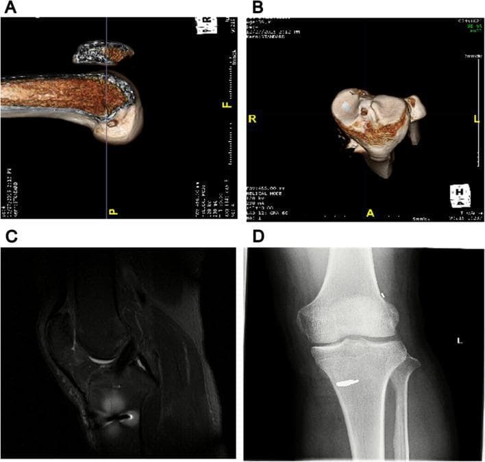 This composite of four clinical diagnostic images illustrates the postoperative evaluation of an anterior cruciate ligament (ACL) reconstruction. Panels A and B present 3D-reconstructed CT images of the distal femur. Panel A shows a longitudinal view of the femoral tunnel, appearing as a cylindrical void within the lateral femoral condyle. Panel B provides a transverse (axial) view, demonstrating the precise circular entry point and orientation of the bone tunnel. Panel C is a sagittal T2-weighted MRI of the knee joint, displaying the ACL graft as a continuous, low-signal (dark) band extending from the tibia to the femur, which suggests a healthy graft without signs of rupture or cyclops lesions. Panel D is an anteroposterior X-ray of the knee, revealing the metallic fixation hardware. A radiopaque interference screw is clearly visible within the tibial tunnel, showing proper alignment and cortical anchoring without evidence of migration or loosening. Collectively, these images demonstrate standard postoperative monitoring for tunnel positioning, graft integrity, and hardware stability in orthopedic sports medicine.