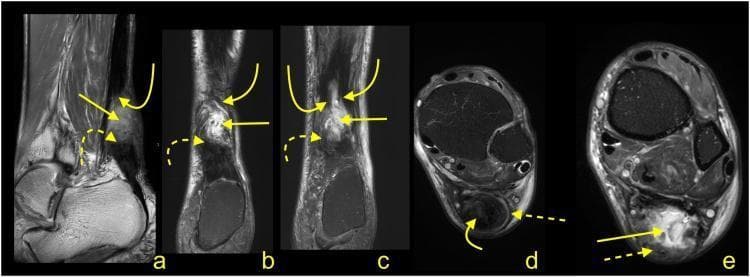 This set of multi-planar MRI images (sagittal, coronal, and axial) illustrates the status of an Achilles tendon four months after a rupture managed with conservative treatment. The modality includes PD-weighted (a), T2-weighted with fat suppression (b, c), and PD-weighted with fat suppression (d, e) sequences. Key diagnostic features include the clear separation of the proximal stump (indicated by curved solid arrows) and the distal stump (indicated by dashed curved arrows), both of which exhibit highly irregular, frayed outlines. Notably, there is a lack of visible fibrotic adhesions bridging the gap between the two stumps, signifying a failure of primary tendon healing or 'non-union'. The paratenon is clearly preserved but demonstrates pathological thickening (indicated by dashed straight arrows), suggesting chronic reactive changes. The surrounding Kager's fat pad and regional soft tissues are otherwise unremarkable. This case serves as an educational example of the long-term MRI appearance of unsuccessful conservative healing in total midportion Achilles tendon ruptures.