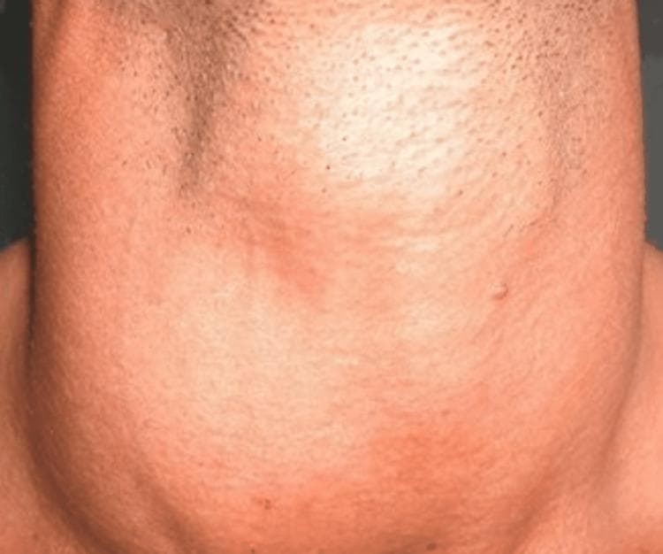 This clinical photograph displays a frontal view of a patient's neck, illustrating a significant and diffuse enlargement of the thyroid gland, clinically referred to as a goiter. The swelling is symmetrical and uniform, extending across the anterior neck and obscuring the typical anatomical contours of the trachea and sternocleidomastoid muscles. The surface of the skin over the mass appears smooth and intact, without visible discrete nodules or localized masses, which is characteristic of diffuse thyroid hyperplasia often seen in Graves' disease. The skin overlying the enlargement exhibits a slight erythematous (reddened) appearance, likely due to increased vascularity or stretching of the integument over the underlying hypertrophied tissue. This visual presentation is a classic physical examination finding in endocrinology for evaluating autoimmune thyroid disorders and thyroid-related mass effects.
