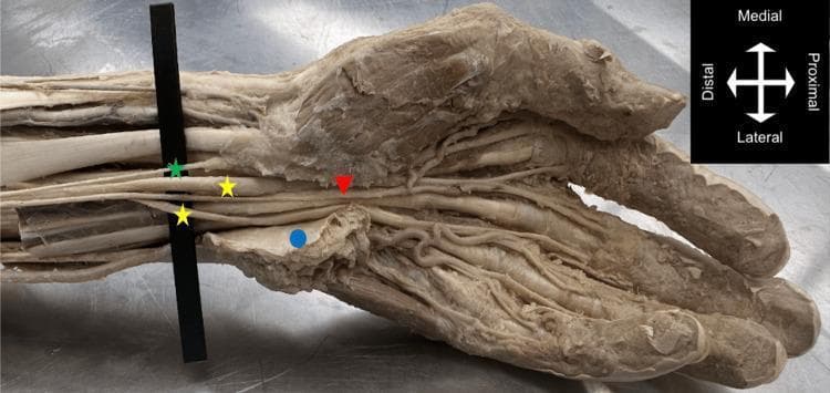 Anatomical dissection of a left distal forearm and hand in anterior view, demonstrating a bifid median nerve (BMN) and a persistent median artery (PMA). The image illustrates the median nerve bifurcating into medial and lateral branches (indicated by yellow stars) proximal to the carpal tunnel. The persistent median artery (red arrow) is seen coursing centrally between these two nerve branches as it passes deep to the flexor retinaculum (blue circle) into the palm. Within the hand, the PMA follows a radial trajectory, contributing to an incomplete superficial palmar arch and supplying the thumb, index, and middle fingers. A palmar branch of the median nerve (green star) is also visible. This photograph highlights a significant anatomical variation where the PMA and BMN coexist, which is clinically relevant for procedures such as carpal tunnel release, as the presence of these structures increases the risk of inadvertent neurovascular injury.
