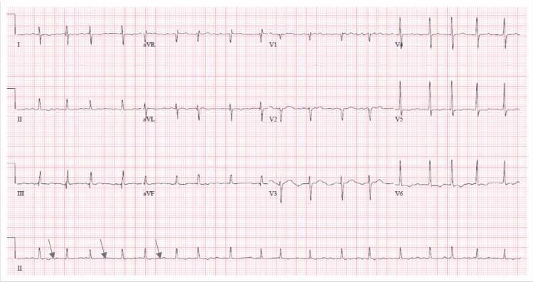This diagnostic image is a 12-lead electrocardiogram (ECG) mounted on a standard grid, displaying leads I, II, III, aVR, aVL, aVF, and V1-V6. The tracing demonstrates an irregularly irregular rhythm characteristic of atrial fibrillation. Key diagnostic features include the absence of distinct P waves, which are replaced by low-amplitude, chaotic fibrillary (f) waves, highlighted by blue arrows in the rhythm strip (lead II at the bottom). The QRS complexes are narrow and occur at varying intervals, indicating an inconsistent ventricular response. The ventricular rate is approximately 108 beats per minute, consistent with a rapid ventricular rate (RVR). There are no significant ST-segment or T-wave abnormalities visible; however, a right axis deviation is present. This ECG serves as an educational example for identifying supraventricular tachyarrhythmias and chaotic atrial electrical activity in a clinical setting.