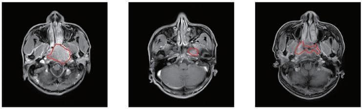 This diagnostic image displays three axial MRI slices of the head and neck at the level of the nasopharynx, illustrating the presentation and manual segmentation of nasopharyngeal carcinoma (NPC). The slices show key anatomical structures including the nasal cavity, sphenoid bone, parapharyngeal spaces, and the base of the skull. Each slice features a red outline representing manual segmentation of the tumor volume. The first image on the left demonstrates a large, centrally located mass with heterogeneous signal intensity that appears to occupy the nasopharyngeal space and potentially invade adjacent structures. The middle image shows a more localized, smaller lesion in the left lateral nasopharyngeal wall near the fossa of Rosenmüller. The third image on the right depicts an irregularly shaped, infiltrative tumor extending across the mucosal surfaces. These slices highlight the challenging clinical task of delineating NPC boundaries due to the primary tumor's proximity to normal soft tissues and its tendency for subtle infiltration, which is a critical step in radiotherapy planning and diagnostic oncology.