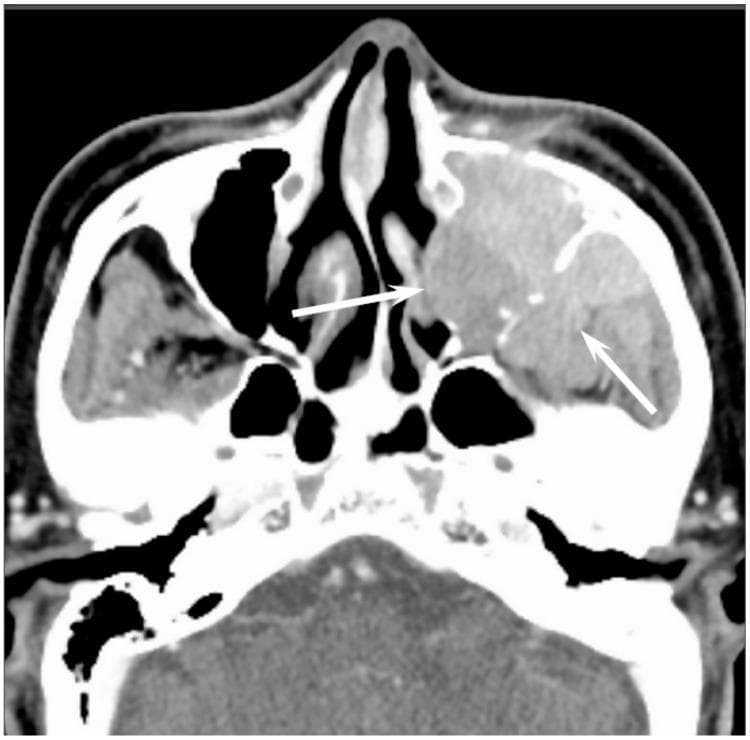 This contrast-enhanced axial CT scan of the midface demonstrates a large, homogeneously enhanced soft-tissue mass originating within the left maxillary sinus, consistent with diffuse large B-cell lymphoma (DLBCL). The lesion fills the entire sinus cavity and exhibits an infiltrative growth pattern. Notably, the remaining sinus walls are visible as thin, linear bony structures submerged within the tumor mass (indicated by white arrows), a characteristic finding of permeative-type tumor invasion often seen in sinonasal non-Hodgkin’s lymphoma. Unlike squamous cell carcinoma, which typically presents with aggressive, destructive bony changes and intratumoral necrosis, this mass shows uniform density and relative preservation of the skeletal framework. The contralateral right maxillary sinus and nasal cavity appear unremarkable. This diagnostic image is used to educate medical professionals on distinguishing sinonasal malignancies based on enhancement patterns and the nature of cortical bone involvement.