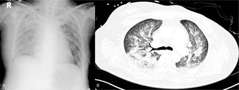 Educational comparison of thoracic imaging modalities in a patient with diffuse alveolar hemorrhage (DAH). Image A is a postoperative anteroposterior (AP) chest radiograph showing extensive, bilateral lung consolidation presenting as ill-defined areas of increased opacity throughout both hemithoraces. Image B is an axial chest computed tomography (CT) scan in lung window at the level of the main bronchi. The CT demonstrates a symmetrical, bilateral peribronchial alveolar pattern characterized by dense consolidations following the airway distribution. Interspersed with these consolidations are diffuse ground-glass opacities (GGO), which indicate partial filling of air spaces or interstitial thickening. The findings are characteristic of severe non-cardiogenic pulmonary edema or acute respiratory distress syndrome (ARDS) manifesting as pulmonary hemorrhage. The comparison highlights the superior sensitivity of CT in localizing the peribronchial distribution of alveolar patterns versus the more generalized consolidation visible on plain film radiography.