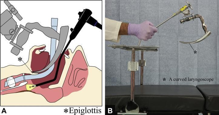 This composite image illustrates a specialized surgical setup for endoscopic procedures in the pharyngo-esophageal region. Part A is a sagittal anatomical diagram showing a patient in the supine position under general anesthesia with an endotracheal tube in situ. A curved laryngoscope is positioned with its tip at the base of the tongue, effectively depressing the tongue and elevating the epiglottis to expand the working space. This allows for the parallel insertion of a flexible gastrointestinal endoscope toward the cervical esophagus. Part B is a clinical photograph of the Nagashima curved laryngoscope. The device is constructed of medical-grade metal, featuring an ergonomic handle and a distinctively curved, tapered blade. The laryngoscope is shown mounted to a rigid vertical stand via a mechanical clamp and adjustable arm, which facilitates stable, hands-free suspension laryngoscopy. This setup is clinically significant for securing a clear operative field during Endoscopic Submucosal Dissection (ESD) of tumors located at the pharyngo-esophageal junction or hypopharynx.