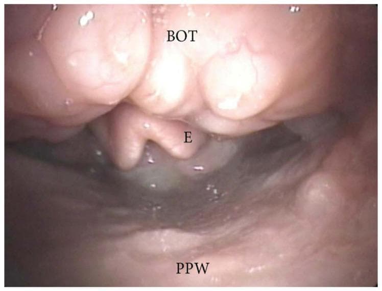This diagnostic endoscopic image, obtained during drug-induced sleep endoscopy (DISE), illustrates the oropharyngeal airway and its anatomical landmarks. The base of the tongue (BOT) is positioned in the superior aspect of the frame, showing significant tissue hypertrophy of the lingual tonsils. This enlargement causes a marked anteroposterior narrowing of the airway space. Inferior to the BOT, the epiglottis (E) is partially visible but obscured by the overriding base of the tongue. The posterior pharyngeal wall (PPW) is seen at the bottom of the image, maintaining a smooth, pink mucosal appearance. The visual evidence confirms a pattern of airway obstruction driven by lingual tonsil hypertrophy, a common finding in patients with obstructive sleep apnea (OSA). The image demonstrates the spatial relationship between the lingual tonsillar tissue and the laryngeal inlet, highlighting the reduction in the cross-sectional area of the pharyngeal lumen.