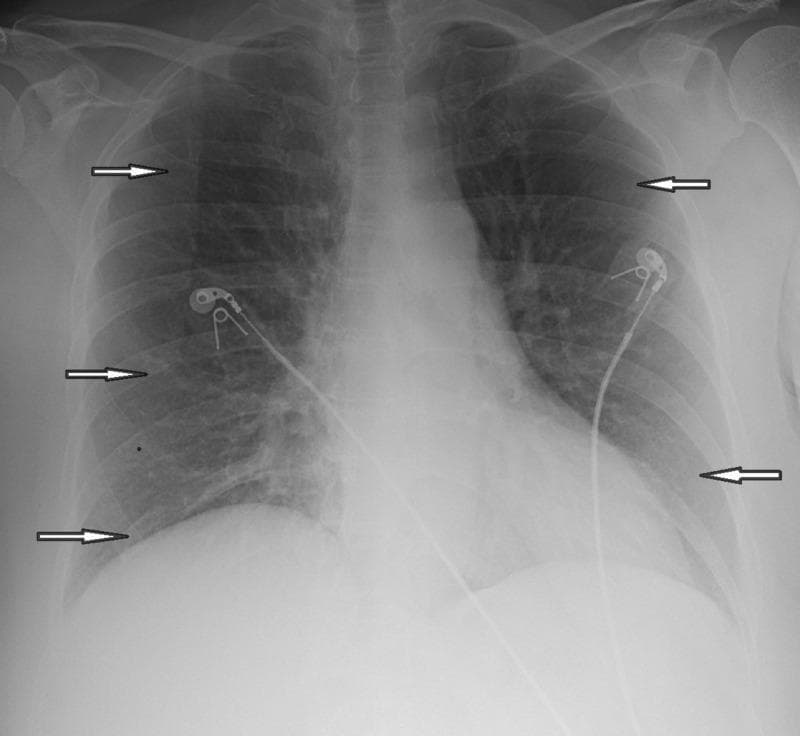This diagnostic image is a posterior-anterior (PA) view chest X-ray illustrating radiological signs of chronic obstructive pulmonary disease (COPD), specifically emphysema. The lung fields exhibit diffuse hyperlucency and signs of hyperinflation, characterized by the flattening of the diaphragmatic domes bilaterally. Multiple white arrows point to areas of increased pulmonary lucency with a relative paucity of vascular markings, consistent with emphysematous parenchyma. There is no evidence of focal consolidation, pleural effusion, or pneumothorax. The cardiomediastinal silhouette and hilar contours appear within normal limits for this view. External medical devices are present, including cardiac monitoring leads and electrodes overlying the mid-thoracic region. The skeletal structures, including the ribs and clavicles, are intact. This image serves as a clinical example for medical students to recognize signs of obstructive lung disease and the visual presentation of pulmonary air-trapping on conventional radiography.