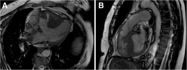 This diagnostic image consists of two panels (A and B) showing Cardiac Magnetic Resonance Imaging (MRI) in a patient with Tetralogy of Fallot. Panel A presents an axial view demonstrating a large ventricular septal defect (VSD) and an overriding aorta, where the aortic root is positioned directly above the septal defect rather than solely over the left ventricle. Panel B provides a sagittal/oblique view highlighting significant right ventricular hypertrophy, characterized by thickened muscular walls of the right ventricle. Additionally, this view illustrates subpulmonary stenosis, visible as an anatomical narrowing of the right ventricular outflow tract (RVOT) below the pulmonary valve. These findings represent the classic morphological components of Tetralogy of Fallot, a cyanotic congenital heart disease. The images serve as an educational example of how cardiac MRI can definitively characterize complex intracardiac shunts, valvular obstructions, and ventricular remodeling for surgical planning.