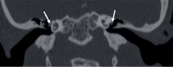 This coronal high-resolution CT (HRCT) image of the temporal bone demonstrates bilateral congenital anomalies of the facial nerve. White arrows highlight the dehiscent tympanic (horizontal) segments of the facial nerve bilaterally. The nerve exhibits an anomalous inferio-medial course, resulting in it abutting the lateral wall of the bony labyrinth. Due to this displacement and the lack of a normal bony canal covering (dehiscence), the facial nerve is positioned in close proximity to the oval window niche. The image also captures the middle ear cavity and the labyrinthine structures of the inner ear. This radiological finding is clinically significant for surgical planning, particularly in cases of conductive hearing loss or planned middle ear surgery (e.g., stapedotomy), as the dehiscent and displaced nerve is at increased risk of accidental injury or may obscure the surgical approach to the oval window.