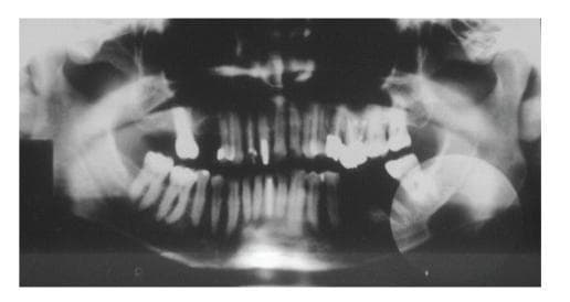 This diagnostic panoramic radiograph (orthopantomogram) of the maxilla and mandible demonstrates a large, well-circumscribed, oval-shaped radiolucent area in the left posterior mandible. The lesion is located below the mandibular canal, specifically in the submandibular fovea region, extending from the second molar area posteriorly toward the mandibular angle. It features a horizontal orientation and a distinct cortical margin. Key anatomical relationships include the apparent thinning of the inferior mandibular border and a close proximity to the mandibular canal; the upper border of the lesion appears to merge with the superior wall of the canal, while the lower canal wall remains visible within the radiolucency. The dental arch shows multiple teeth with radiopaque restorations and evidence of endodontic treatment. The clinical appearance and location are highly characteristic of a Stafne bone defect (static bone cavity), representing a developmental depression on the lingual surface of the mandible often containing salivary gland tissue. This image is an essential educational example for differentiating benign anatomical variants from cystic or neoplastic mandibular pathologies.