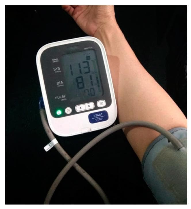 This clinical photograph shows a digital automated blood pressure measurement device in use. The device features a large liquid crystal display (LCD) screen providing three primary physiological metrics: systolic blood pressure (SYS), diastolic blood pressure (DIA), and pulse rate. The visible reading shows a systolic pressure of 113 mmHg, a diastolic pressure of 81 mmHg, and a pulse of 70 beats per minute. A flexible rubber tube connects the monitor unit to an inflatable cuff positioned around the user's upper arm, demonstrating a standard non-invasive blood pressure (NIBP) monitoring setup. The interface includes a prominent 'START/STOP' button and secondary navigation buttons for memory or time settings. This visual illustrates common medical technology used for cardiovascular health monitoring and hypertension screening in both clinical and home settings. The image highlights the integration of electronic sensors and oscillometric techniques to replace traditional manual auscultation.
