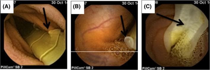 Diagnostic imaging via capsule endoscopy (PillCam SB 2) capturing Taenia saginata (beef tapeworm) infestation within the human small intestine. Panel A displays the yellowish, translucent strobila with a prominent arrow indicating a lateral genital pore on a proglottid. Panel B shows a close-up of a genital pore against the backdrop of the intestinal mucosa and intraluminal air bubbles. Panel C demonstrates a gravid proglottid with a visible internal uterine system, appearing more opaque and textured compared to immature segments. These clinical images highlight the utility of video capsule endoscopy in detecting intestinal helminths and differentiating species based on morphological features, such as the number and pattern of uterine branches. Taenia saginata typically presents with 15-20 uterine branches, a key diagnostic feature distinguishing it from the rosette-shaped uterus of Diphyllobothrium latum. The presence of these parasites is often a consideration in the differential diagnosis of unexplained abdominal symptoms or iron deficiency anemia when standard upper and lower endoscopies are normal.