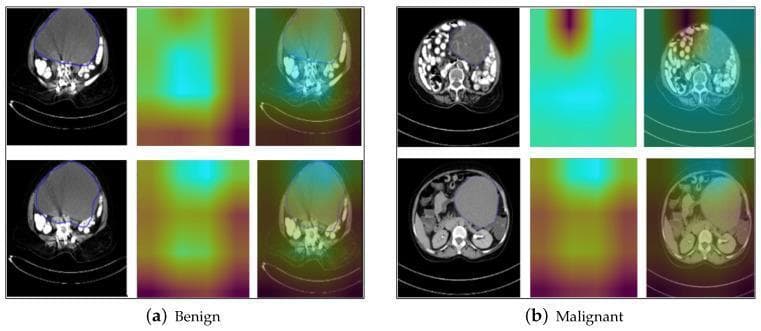 A diagnostic imaging comparison featuring Grad-CAM (Gradient-weighted Class Activation Mapping) results for benign and malignant ovarian tumor classification using axial CT scans. The figure is divided into two sections: (a) Benign and (b) Malignant samples. Each section displays three columns: the original cropped CT image with manual annotation outlines, the standalone Grad-CAM heatmap, and the heatmap overlaid on the CT image. The benign samples demonstrate tumors with relatively smooth, well-defined boundaries and more homogeneous internal textures; the corresponding Grad-CAM heatmaps show concentrated, localized activation areas. In contrast, the malignant samples display tumors with irregular shapes and less distinct margins. The Grad-CAM heatmaps for the malignant class show broader, more dispersed activation regions that extend into the surrounding pelvic tissue, suggesting the model utilizes features of potential local spread or invasion for classification. This comparison illustrates how deep learning interpretability tools identify morphological and peri-tumoral characteristics used to differentiate tumor types in gynecological oncology.