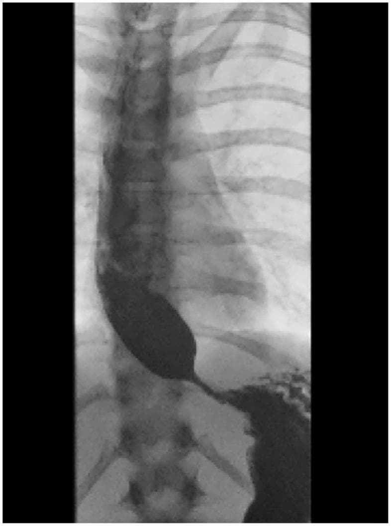 This diagnostic image is a barium swallow fluoroscopy (upper gastrointestinal series) radiograph of the chest and upper abdomen, demonstrating a classic 'bird-beak' appearance of the distal esophagus. The image shows significant proximal esophageal dilation filled with radiopaque barium contrast material. At the level of the gastroesophageal junction, there is a smooth, tapered, and symmetrical narrowing where the contrast terminates in a sharp point before entering the stomach. This visual sign is highly characteristic of achalasia, a primary esophageal motility disorder characterized by failure of the lower esophageal sphincter (LES) to relax and absent peristalsis. The background anatomy includes the thoracic vertebral column and ribs, which are positioned posterior to the dilated esophagus. The image serves as a definitive educational example of esophageal stasis and obstructive pathophysiology at the LES, often used for training in gastroenterology and radiology for the diagnosis of Type I or Type II achalasia.