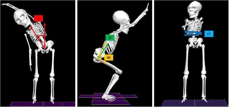 This medical anatomical diagram illustrates the three-dimensional biomechanical analysis of joint angles using a human skeletal model, relevant for clinical motion analysis and physical assessment. The image is divided into three panels representing different anatomical planes. Panel I (left) shows the Coronal Plane, demonstrating the Thorax-with-respect-to-Pelvis (TWRP) bend angle, indicated by red arrows measuring lateral flexion from the pelvic midline. Panel II and III (middle) illustrate the Sagittal Plane during a squatting motion; green arrows define the TWRP flexion/extension angle (II), while yellow arrows define the hip flexion/extension angle (III) relative to the femur and pelvis. Panel IV (right) shows the Transverse Plane, with a blue circular arrow indicating TWRP rotation around the vertical axis. These visual representations are used in biomechanical studies to quantify range of motion (maxROM) and movement symmetry during standardized tests like the Biomechanical Assessment and Symmetry Evaluation (BASE). The diagram serves as an educational tool for understanding segmental orientation and musculoskeletal kinematics in pain management and physical rehabilitation contexts.
