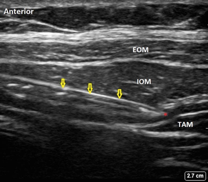 This diagnostic ultrasound image demonstrates the performance of a Transversus Abdominis Plane (TAP) block, a regional anesthesia technique. The image shows the layered anatomy of the lateral abdominal wall, with individual muscles clearly labeled: the External Oblique Muscle (EOM), Internal Oblique Muscle (IOM), and Transversus Abdominis Muscle (TAM). These muscle layers are separated by echogenic (bright) fascial planes. A highly echogenic, linear structure representing a block needle or catheter is identified by yellow arrows. It is positioned in an in-plane approach, traveling through the fascial plane located specifically between the IOM and TAM. A red asterisk marks the distal tip of the needle, where a small hypoechoic (dark) area indicates the initial administration of local anesthetic or saline (injectate), confirming correct placement within the target plane. The 'Anterior' orientation is noted on the left of the frame, and a scale bar in the bottom right indicates a depth of 2.7 cm. This image serves as an educational example of real-time needle guidance and anatomical identification for truncal nerve blocks.