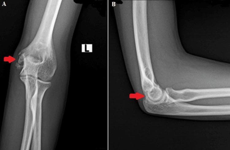 This diagnostic image consists of two radiographic views of the left elbow joint: an anteroposterior (AP) view (A) and a lateral view (B). The X-rays demonstrate the skeletal anatomy of the distal humerus, proximal radius, and proximal ulna. In the AP view, a red arrow points to the medial epicondyle of the humerus, where the bony architecture appears preserved with normal cortical thickness and trabecular patterns. The radiohumeral and ulnohumeral joint spaces are well-maintained, indicating a lack of significant degenerative changes or acute inflammatory destruction. The lateral view shows congruent alignment of the humeroulnar and radiocapitellar joints, with the red arrow again highlighting the medial epicondylar region from a side profile. These follow-up images show no evidence of active lytic lesions, cortical erosions, or recurrence of previously treated disease such as musculoskeletal tuberculosis. The surrounding soft tissues appear normal without significant swelling or calcification, confirming clinical stability at one year post-treatment.