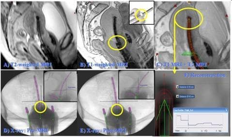 This composite figure illustrates the multi-modality imaging reconstruction of a titanium Tandem and Ovoid (T&O) brachytherapy applicator for cervical cancer treatment planning. (a) A sagittal T2-weighted MRI shows anatomical detail of the uterus and pelvic structures with 3 mm slice thickness. (b) A sagittal T1-weighted MRI highlights the applicator's cervical marker (flange) with high contrast, essential for position verification. (c) A fused T1 and T2 MRI image overlays the high-contrast applicator details onto the anatomical background for precise localization. (d) and (e) display orthogonal X-ray projections acquired prior to and following the MRI scan, respectively; yellow circles identify the flange position to calculate movement (Δd) and ensure reconstruction accuracy. (f) Provides a detailed view of the reconstructed tandem tip on MR, including an intensity profile used to account for artifacts and catheter thickness. This series demonstrates the clinical workflow for validating 3D MRI-based high-dose-rate (HDR) brachytherapy planning using multiple imaging modalities to minimize uncertainty in applicator reconstruction.