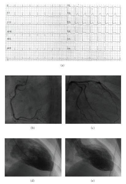 A multi-panel clinical figure documenting a case of Takotsubo Cardiomyopathy (Stress-Induced Cardiomyopathy). Panel (a) shows a 12-lead electrocardiogram (ECG) with prominent ST-segment elevation in the anterior precordial leads (V1–V6), mimicking an acute myocardial infarction. Panels (b) and (c) are coronary angiograms showing patent, normal right and left coronary arteries, respectively, without significant obstructive atherosclerosis or stenosis. Panels (d) and (e) present contrast left ventriculography in the right anterior oblique (RAO) projection. Panel (d) represents end-diastole with a relatively normal ventricular volume. Panel (e) represents end-systole, demonstrating the hallmark 'apical ballooning' pattern characterized by apical akinesia and compensatory hyperkinesis of the basal segments. The combined findings—ischemic ECG changes, absence of obstructive coronary artery disease, and characteristic regional wall motion abnormalities—are classic for Takotsubo syndrome, illustrating a clinical scenario often presenting as an acute coronary syndrome mimic.